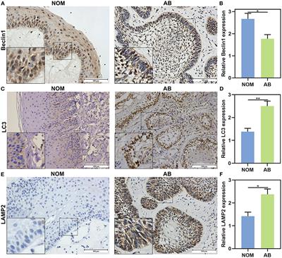 MicroRNA-1-3p Suppresses Malignant Phenotypes of Ameloblastoma Through Down-Regulating Lysosomal Associated Membrane Protein 2-Mediated Autophagy